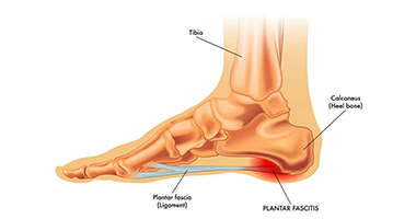 足底筋膜炎的十种疼痛管理方法